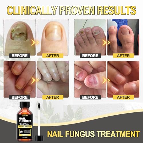 Toenail Fungus Treatment Extra Strength - Nail Fungus Treatment for Toenail - 30ml F9815