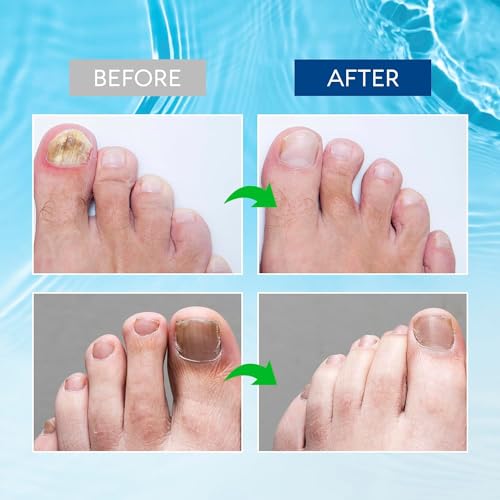 Toenail Fungus Treatment Extra Strength - 30 ml X75489